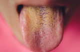 Nếu kiểm tra lưỡi có màu vàng, hãy cẩn trọng với 5 bệnh này