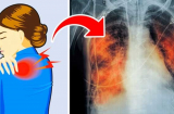 Các dấu hiệu cảnh báo bệnh phổi. Xem bạn có dấu hiệu nào không?