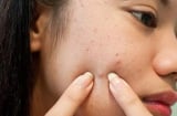 6 sai lầm phổ biến khi chăm sóc da mà bạn cần phải tránh nếu không muốn da xuống cấp