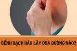 Bệnh bạch hầu lây qua đường nào, làm sao để phòng tránh?