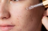 Da mụn dùng retinol như thế nào?