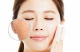 Mẹo giúp se khít lỗ chân lông da mặt hiệu quả, đơn giản