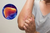 7 dấu hiệu cảnh báo bệnh gan đã đi vào giai đoạn nặng