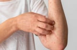 8 dấu hiệu cảnh báo bạn đang mắc bệnh thận giai đoạn nặng: Có 1 cũng nên đi khám gấp