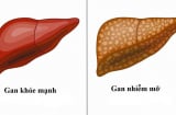 Gan nhiễm mỡ có gây ung thư gan? Chuyên gia cảnh báo dấu hiệu cần biết sớm