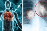 90% ca ung thư phổi ở nam giới Việt: Thói quen này là thủ phạm chính bạn cần biết!