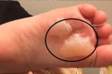Cách chữa phồng rộp da chân khi đi bộ nhiều, mang giày chật