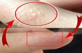 Tay  mọc mụn nước li ti có sao không?