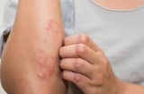 ５dấu hiệu cảnh báo bạn đang mắc bệnh thận giai đoạn nặng: Có 1 cũng nên đi khám sớm