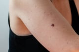 Cảnh báo: Đốm nhỏ trên da có thể là dấu hiệu ung thư – Đừng chủ quan