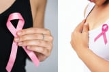 12 nhóm phụ nữ có nguy cơ Ung Thư Vú cao, chú ý xem bạn thuộc nhóm này không