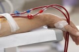 7 dấu hiệu suy thận giai đoạn cuối: Chủ quan tính mạng tính bằng tháng