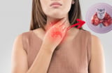 Ung thư tuyến giáp là mối đe dọa âm thầm: 6 có nhóm người dễ mắc bệnh này, nhất định phải thận trọng