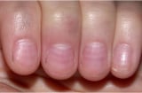 Nhìn móng tay bắt bệnh cực chuẩn