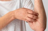 4 dấu hiệu cảnh báo K sớm: Có 1 cũng nên đi khám sớm