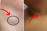 Người sắp bị K thường có 3 dấu hiệu bất thường ở cổ: Dù chỉ có 1 cũng phải đi khám ngay