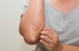 4 dấu hiệu cảnh báo thận của bạn đang kêu cứu: Có 1 cũng nên đi khám sớm