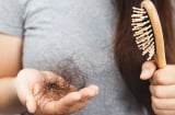 Càng ăn 5 loại thực phẩm này, tóc càng rụng nhiều: Món số 1 được nhiều người yêu thích