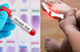 8 cách đơn giản giúp đào thải axit uric ra khỏi cơ thể, phòng ngừa bệnh gout