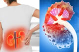 8 dấu hiệu suy thận nhẹ bị nhiều người bỏ qua, chỉ tới lúc nặng mới biết