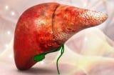 9 dấu hiệu cảnh báo ung thư gan giai đoạn đầu