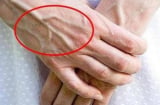 Vì sao tay xuất hiện gân xanh? Cẩn thận nếu bạn có ở những vị trí này!
