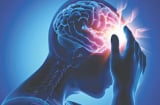 Ông Hoàng Nam Tiến qua đời vì đột quỵ: Dấu hiệu nhận biết đột quỵ trước 1 tuần là gì?