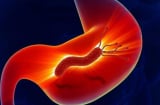 6 dấu hiệu tưởng nhẹ nhưng là 'mồi nhử' ung thư: Đừng chủ quan nếu bạn mắc phải