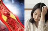 4 việc giúp làm sạch mạch máu, ngăn ngừa lão hóa