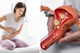 Dấu hiểu cảnh báo K cổ tử cung sớm: Phụ Nữ u 40 đang khoẻ mạnh cũng chớ xem thường