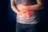 4 dấu hiệu cảnh báo bệnh dạ dày đã đi vào giai đoạn nặng: Có 1 cũng nên đi khám sớm