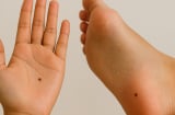 6 vị trí nốt ruồi dễ biến đổi thành ung thư: Đừng chủ quan bỏ qua