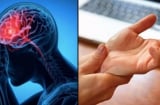 Dấu hiệu cảnh báo đột quỵ trước một tuần tuyệt đối đừng bỏ qua