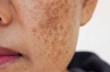 Cảnh báo ung thư: 5 vùng cơ thể đổi màu đen, dấu hiệu sớm nhiều người bỏ qua