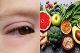 Mắt xuất hiện 3 dấu hiệu bất thường, coi chừng cholesterol trong máu quá cao: Khi rửa mặt nhất định phải chú ý