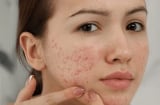 5 tác hại khi không rửa mặt sau khi đắp mặt nạ mà nhiều người không ngờ tới