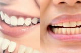 Nhìn màu răng đoán bệnh: Bác sĩ cảnh báo dấu hiệu nguy hiểm nhiều người bỏ qua