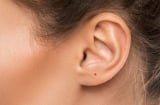 Nốt ruồi son là gì? Giải mã nốt ruồi son ở từng vị trí trên cơ thể