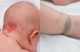 Cảnh báo: Những dấu hiệu 'nốt ruồi son - bớt - vết chàm' trên trẻ có thể tiềm ẩn nguy cơ bệnh lý