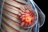 8 kiểu phụ nữ dễ bị K vú nhất: Xem bạn có trong số đó?