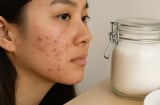 Ăn quá nhiều đường mà không biết: 7 dấu hiệu âm thầm dễ bị bỏ qua
