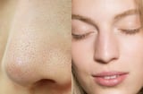 Ghim ngay 3 tips trị mụn cám vừa rẻ vừa hiệu quả chẳng tốn tiền đi spa