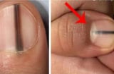 Móng tay có dấu hiệu này là gan đang 'kêu cứu', đến gặp bác sĩ ngay!