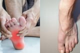 Hai bàn chân xuất hiện 5 dấu hiệu lạ, coi chừng gan đang 'kêu cứu': Hãy đi khám ngay đừng chủ quan