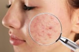 Cẩm nang chăm sóc các loại mụn ẩn nàng nên biết