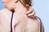 Nguyên nhân gây ra mụn lưng và biện pháp khắc phục tình trạng này.