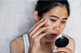 2 lưu ý cơ bản giúp cải thiện tình trạng da xỉn màu, sạm đen