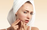 3 nguyên tắc cơ bản khi giảm sưng mụn viêm giúp da khỏe và nhanh láng mịn