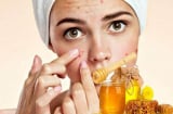 Mật ong hoàn toàn có thể trở thành “trợ thủ” cho da mụn nếu nàng nắm rõ những điểm sau
