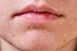 4 dấu hiệu thay đổi trên khuôn mặt cảnh báo ung thư cổ tử cung, phụ nữ cần lưu ý ngay